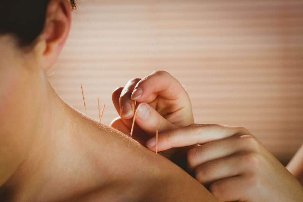 Woman getting a Burnaby acupuncture treatment in the shoulders and back