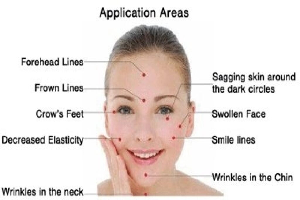 Application areas in face for facial rejuvenation acupuncture in Burnaby