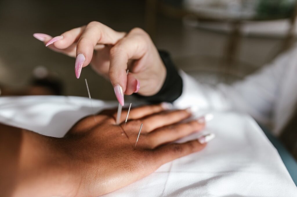 female burnaby acupuncturist inserting needles into the hand of a female patient