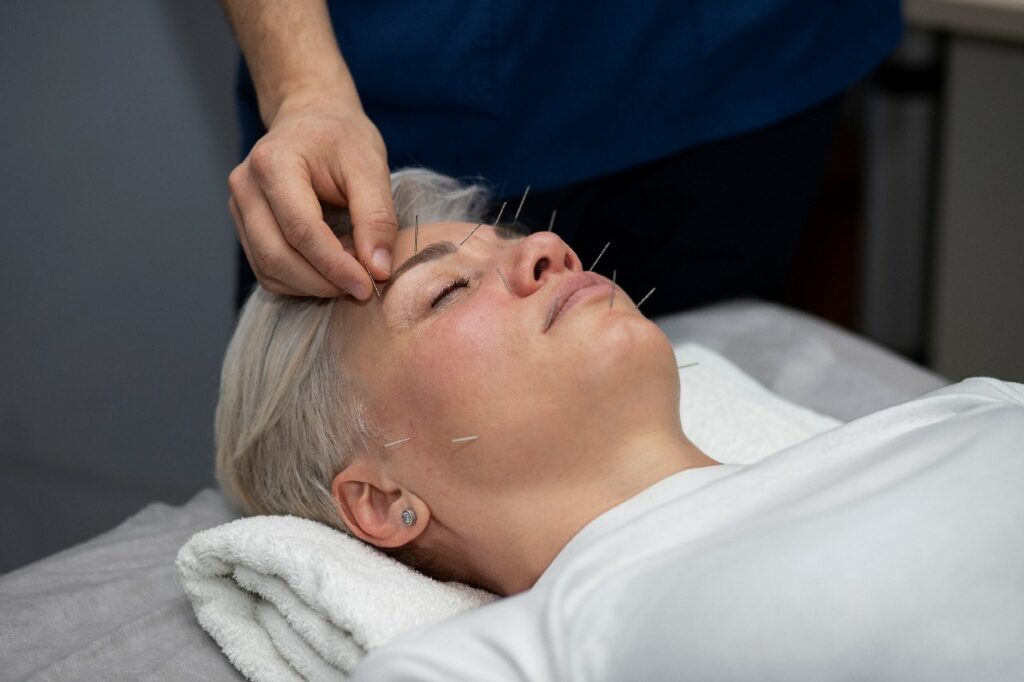female Patient having a facial rejuvenation acupuncture in burnaby