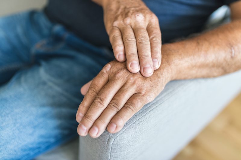 Elderly man suffering from eczema on handseczema flare up immune system immune system anti inflammatory properties treatment of eczema  naturopathic doctor focuses 