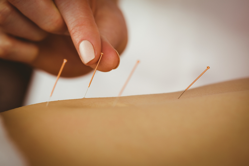 8 Acupuncture is Good After a Car Accident for Many Common Injuries