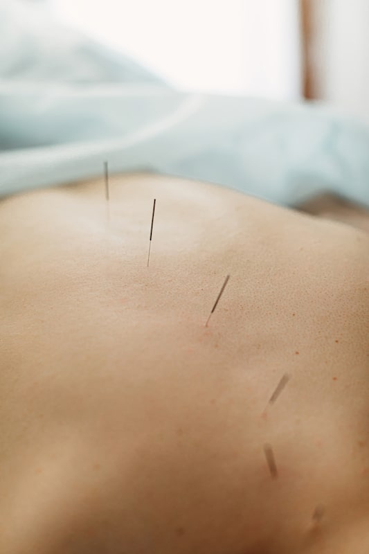 burnaby-acupuncture-clinic