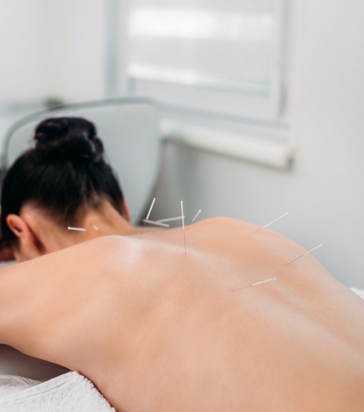 Woman-getting-burnaby-acupuncture-for-pain-management