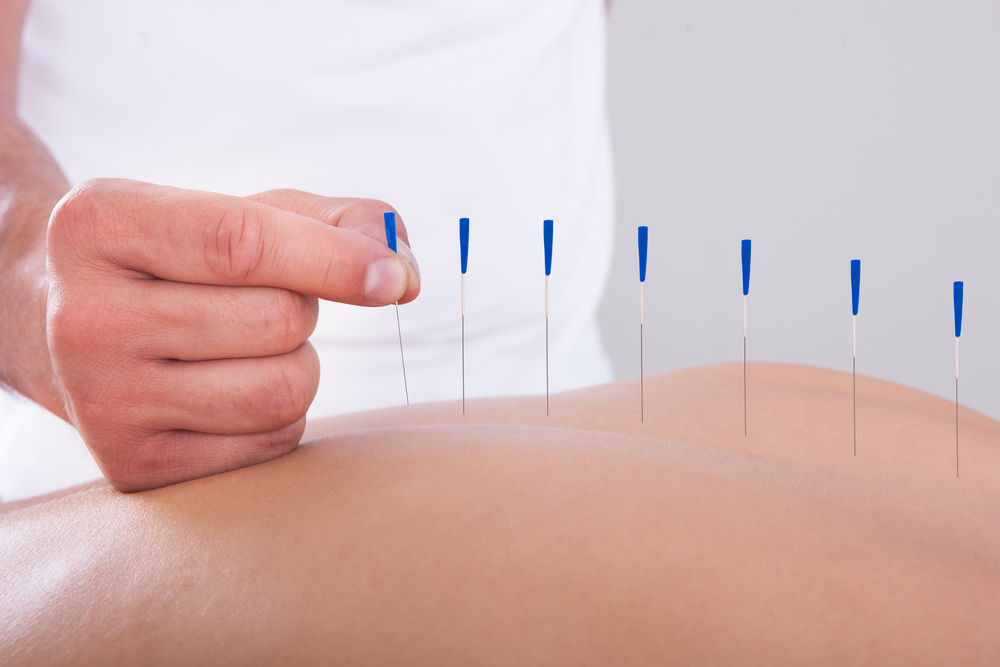 A person receiving acupuncture treatment with fine needles anti inflammatory effect, blood flow