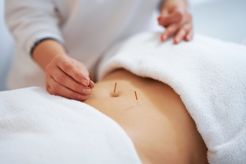 Woman getting Acupuncture to Help with Getting Pregnant naturally